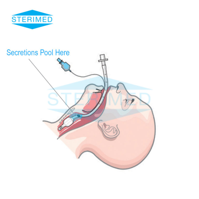 Endotracheal Tube with Subglottic Suction Line | Sterimed | Foley ...